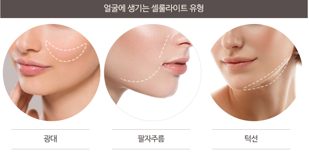 얼굴에 생기는 셀룰라이트 유형
