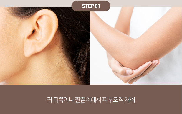 섬유아세포치료 