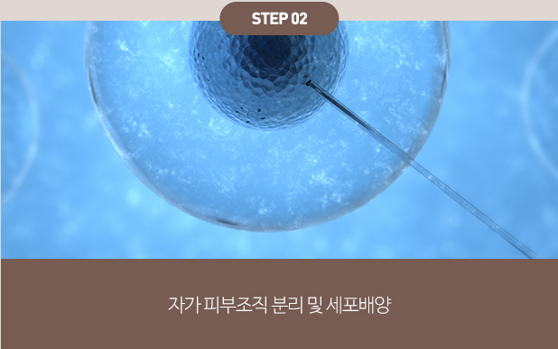 섬유아세포치료 
