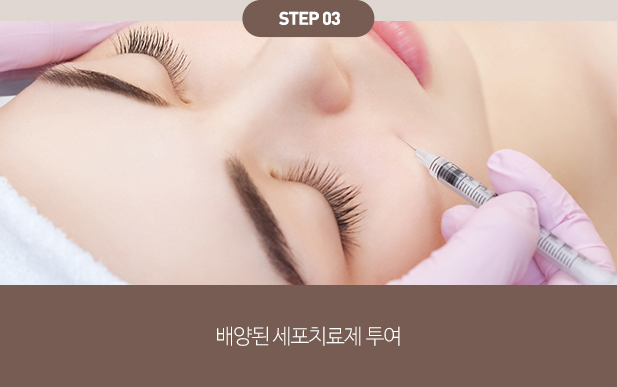 섬유아세포치료 