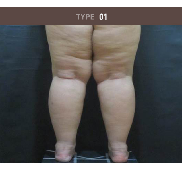 비만·셀룰라이트