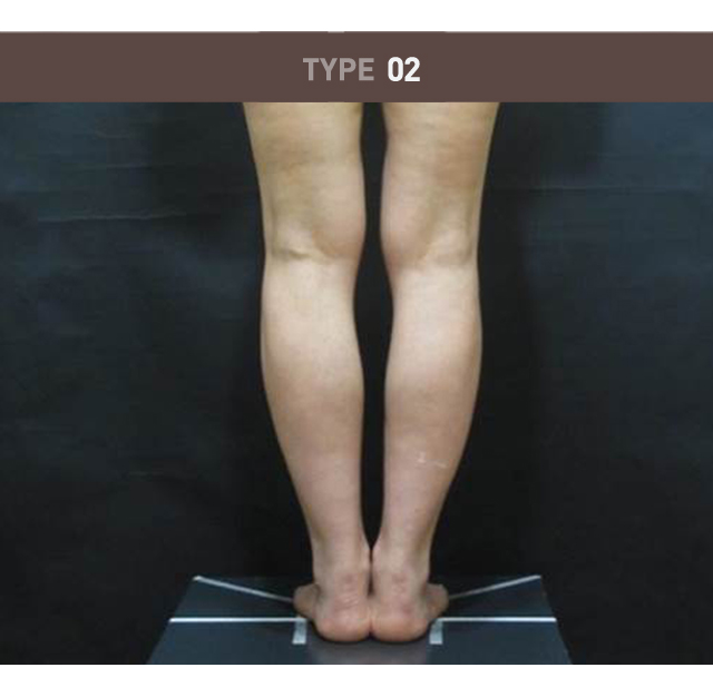 비만·셀룰라이트